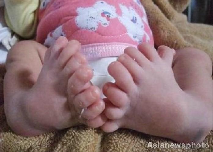 Un bébé naît avec 8 orteils à chaque pied