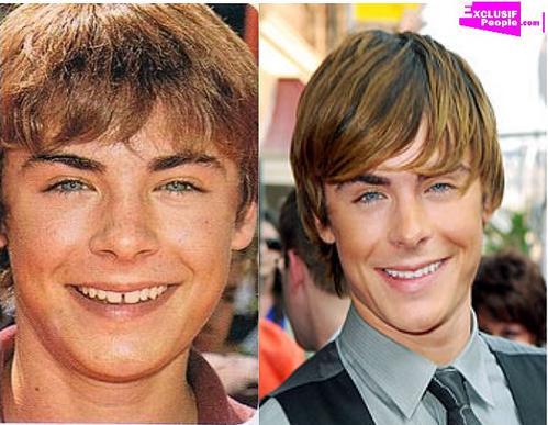 Zac Efron s'est fait refaire les dents !