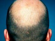 chute-cheveux-calvitie-image