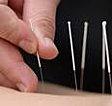 L'acupuncture