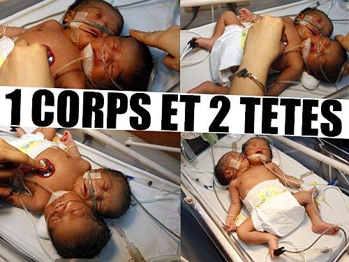 UN BEBE A 2 TETES NE AUX PHILIPPINES ! (LES PHOTOS)