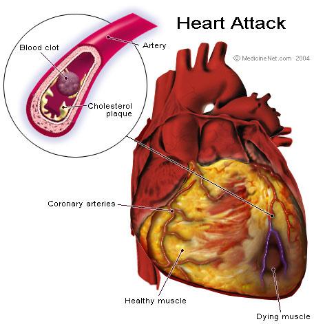 heart attack anatomy par gandhiji40