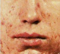 Comme lutter avec les traces sur la personne des boutons