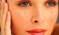 Solutions naturelles pour les Taches de la peau Eliminer les tâches de la peau
