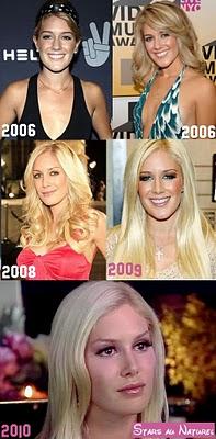 heidi montag surgery