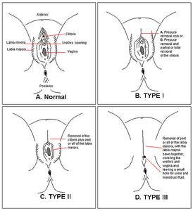 Sexe, mensonges et trahison Excision