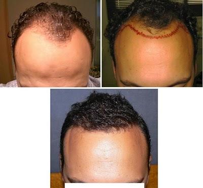 Greffe De Cheveux