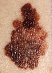 Cancer de la peau : comment reconnaître un mélanome malin
