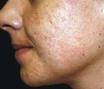 conseils pratique pour combattre l'acné chez les ados