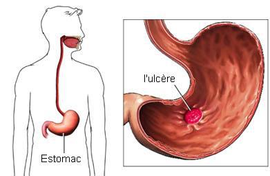 L'oncologie de l'ulcère gastro-duodénal