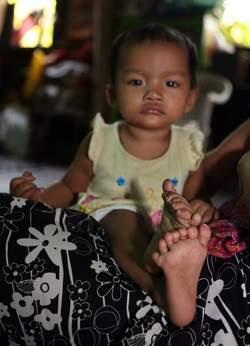 Une fillette naît avec 14 orteils et 12 doigts fillettebirmanie2