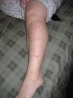 Conseils pour soigner le psoriasis naturellement Soulager et soigner le psoriasis