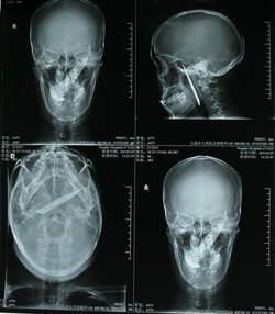 Cinq ans avec un couteau dans la tête couteau3