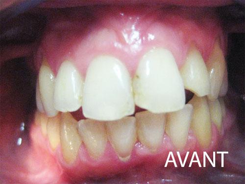 Cas clinique : couronne CEREC tout céramique sur dent vivante (22) en 1 séance