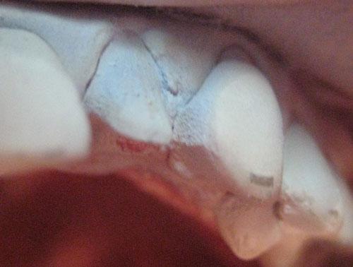 Cas clinique : couronne CEREC tout céramique sur dent vivante (22) en 1 séance