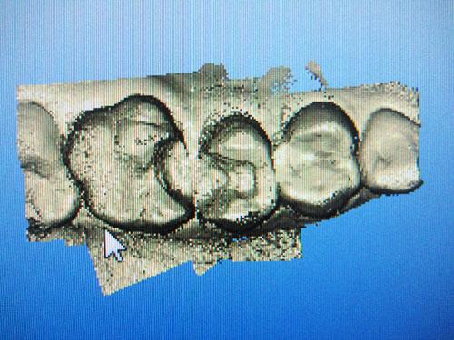 Reconstitution de points de contact par Inlays CEREC en mode quadrant