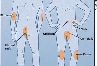 Les bons onguents du psoriasis les rappels