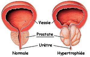 Éviter le cancer prostatique