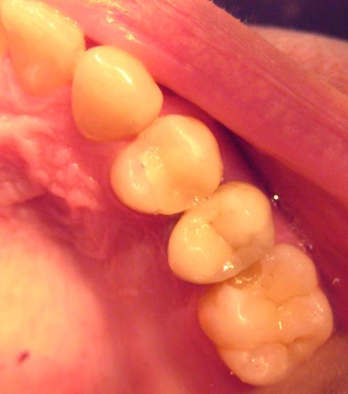 Cas clinique : onlay CEREC sur 24 en remplacement d'un onlay en alliage précieux