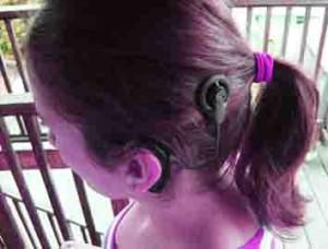 cochleaire-implant-surdite-depistage-naissance