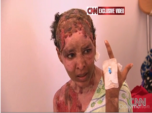 Mullah, 30 ans, brulée et tabassée par le couple Hannibal Kadhafi qui a trouvé refuge en Algérie
