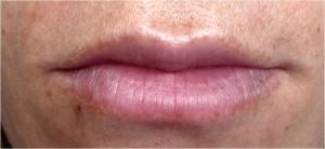 Taches pigmentaires contour des lèvres