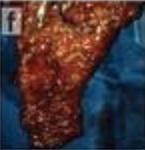 Chirurgie du CANCER : Un colorant fluorescent pour taguer les cellules cancéreuses – Nature Medicine Chirurgie du CANCER : Un colorant fluorescent pour taguer les cellules cancéreuses – Nature Medicine