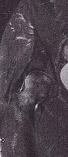 Algoneurodystrophie de la hanche Algoneurodystrophie de la hanche