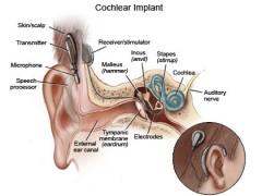 implants cochléaires