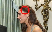 Kate Middleton, c'est quoi cette cicatrice ?