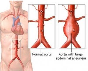 ANÉVRISME de l’aorte abdominale: Première identification d’un gène responsable – The American Journal of Human Genetics