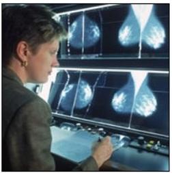 CANCER du SEIN: Y-a-t-il surdépistage? Surdiagnostic?  – British Medical Journal