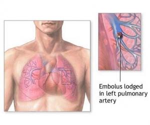 Maladies AUTO-IMMUNES: Multiplication du risque d’embolie pulmonaire – The Lancet