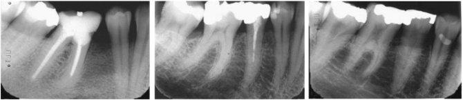 Des radiographies dentaires pour prédire le risque de fractures