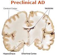 ALZHEIMER: La stimulation cérébrale profonde pour retrouver la mémoire? – NEJM ALZHEIMER: La stimulation cérébrale profonde pour retrouver la mémoire? – NEJM