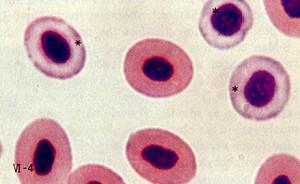 reticulocytes Comprendre les résultats des globules rouges dans une prise de sang.