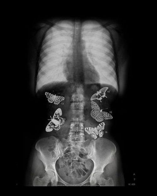 avoir des papillons dans le ventre