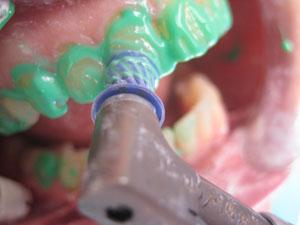 le Nettoyage Prophylactique Professionnel des Surfaces Dentaires