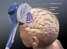 neuromodulation acoustique CR, hyperactivité nerveuse