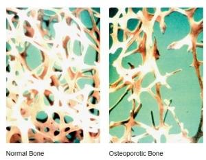 OSTÉOPOROSE: Découverte de 14 variants génétiques associés au risque de fracture – Nature Genetics