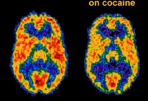 COCAÏNE: Elle accélère considérablement le vieillissement du cerveau  – Molecular Psychiatry