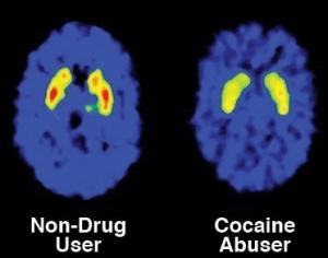 COCAÏNE: Elle accélère considérablement le vieillissement du cerveau  – Molecular Psychiatry