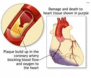 INFARCTUS: Une lumière intense pour traiter les crises cardiaques – Nature Medicine