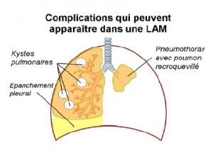 Journée mondiale de la LAM: 200 femmes en France attendent un traitement – Association FLAM