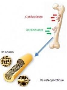OSTÉOPOROSE: 2 tiers des fractures touchent les personnes d’âge extrême – EULAR-Annals of Rheumatic Diseases