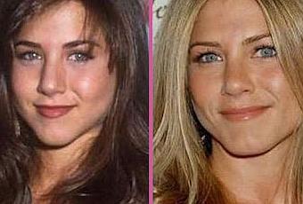 jennifer aniston chirurgie