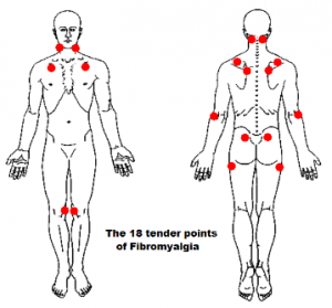 fibromyalgie points douloureux fibromyalgie points douloureux