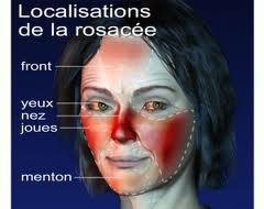 Le traitement chirurgical à mezenterialnom la thrombose