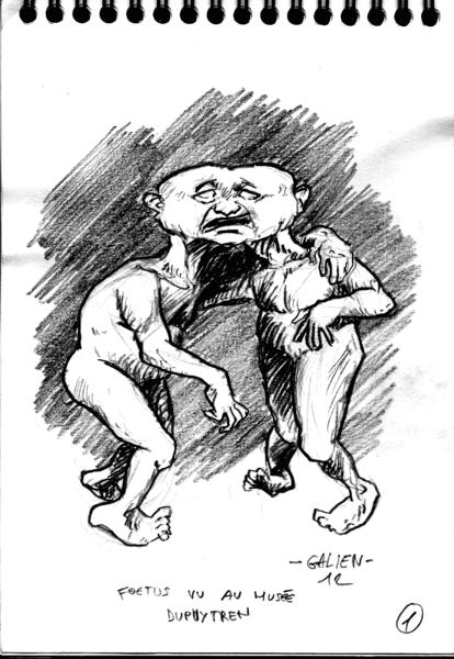 Horreurs génétiques nl2-01dupuytren