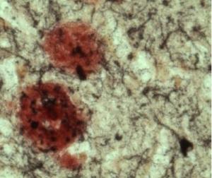 ALZHEIMER: L’enzyme qui frappe toujours deux fois – The Journal of Neuroscience